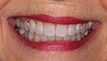 Closeup of gorgeous smile after teeth whitening