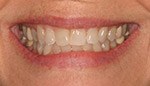 Closeup of darkly discolored teeth