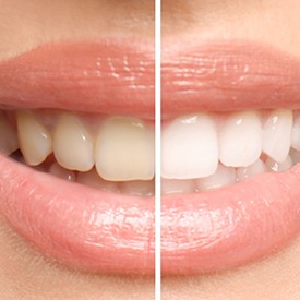 Closeup of before and after teeth whitening in Mesquite