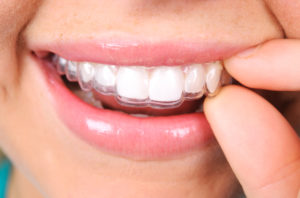 Do you have any more Invisalign questions for your Mesquite Dentist?