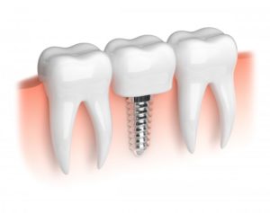 3D illustration of dental implants in mesquite