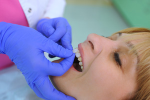 Veneer being placed on a tooth